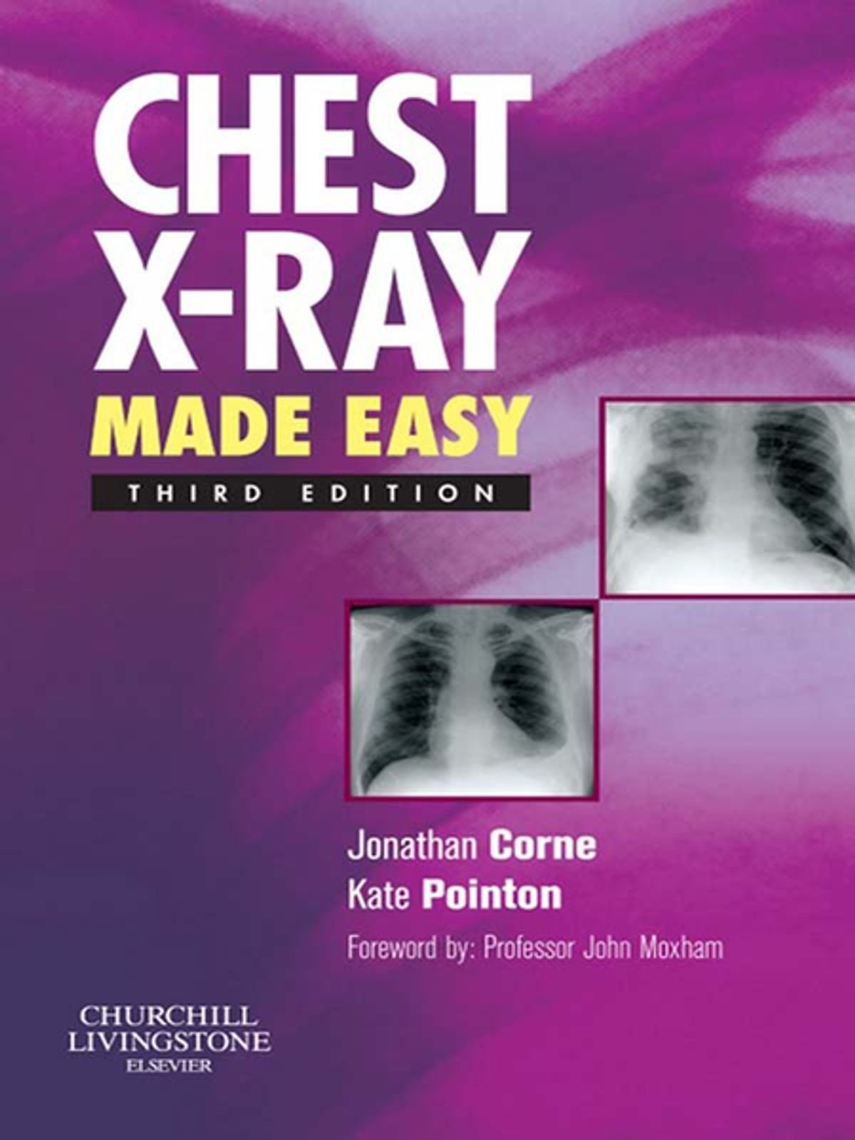 CHEST X-RAY